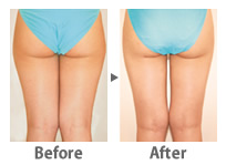 �����N���j�b�N���z�@Before��After