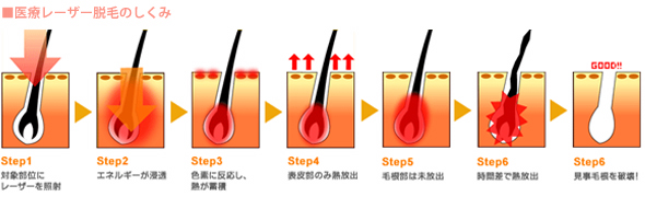 医療レーザー脱毛のしくみ