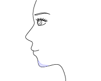 プロテーゼによるあご形成