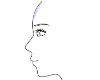 額プロテーゼ
